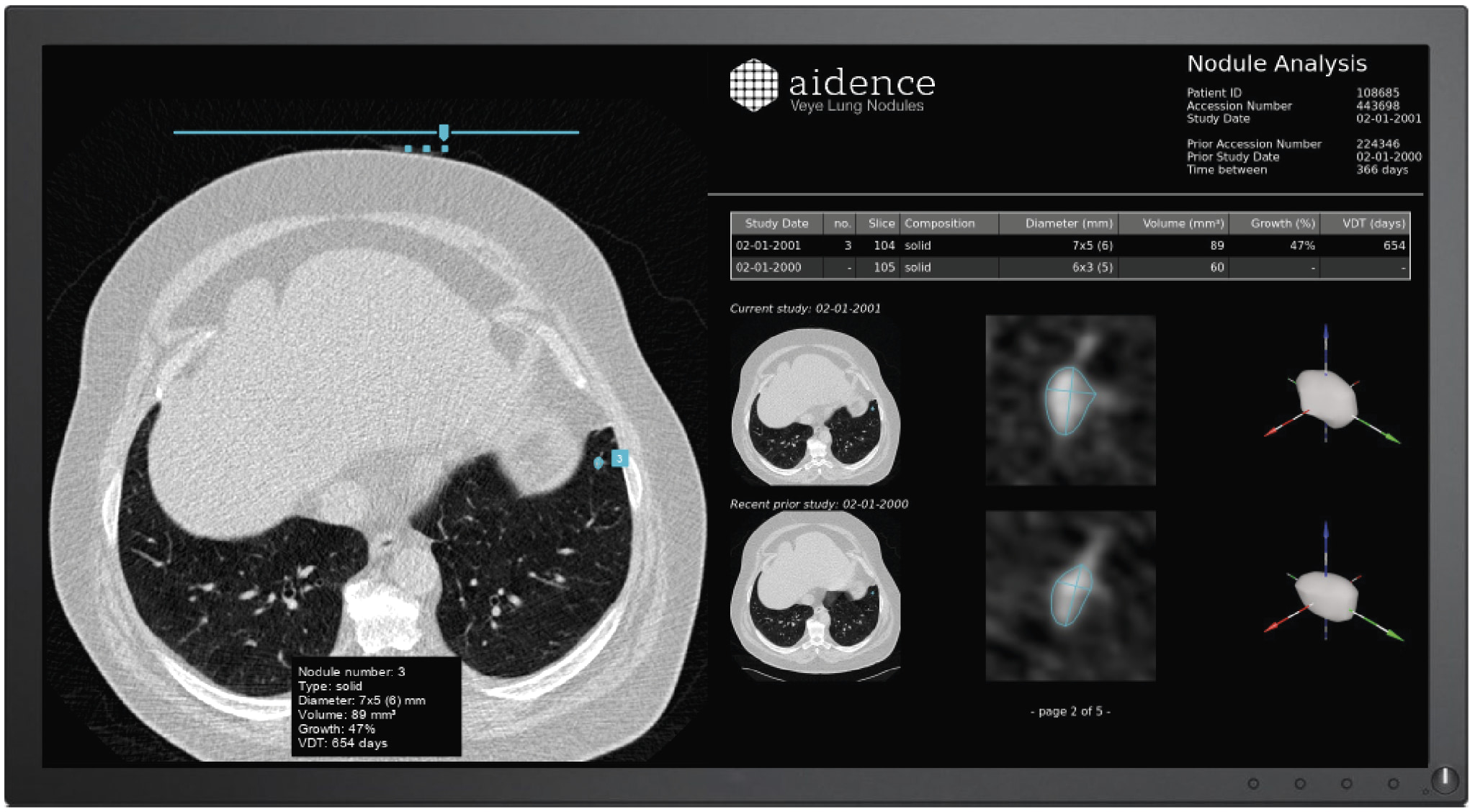 Il sistema di Aidence aiuta a rilevare, misurare, classificare e seguire la crescita dei noduli polmonari - Immagine di Veye Lung Nodules.