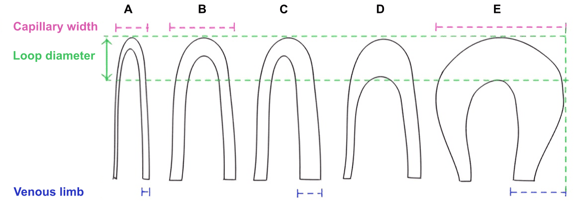 Morfologia dei capillari: (A) ansa capillare normale, (B) ansa capillare afferente ingrandita, (C) ansa capillare efferente ingrandita, (D) ansa capillare apicale ingrandita ed (E) ansa gigante a ferro di cavallo. Fonte: Nailfold Capillaroscopy in Rheumatic Diseases: Which Parameters Should Be Evaluated?