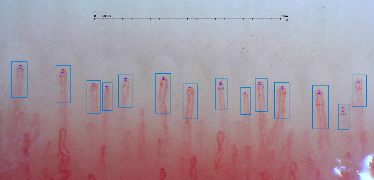 Esempio di capillaroscopia in cui si possono osservare capillari normali