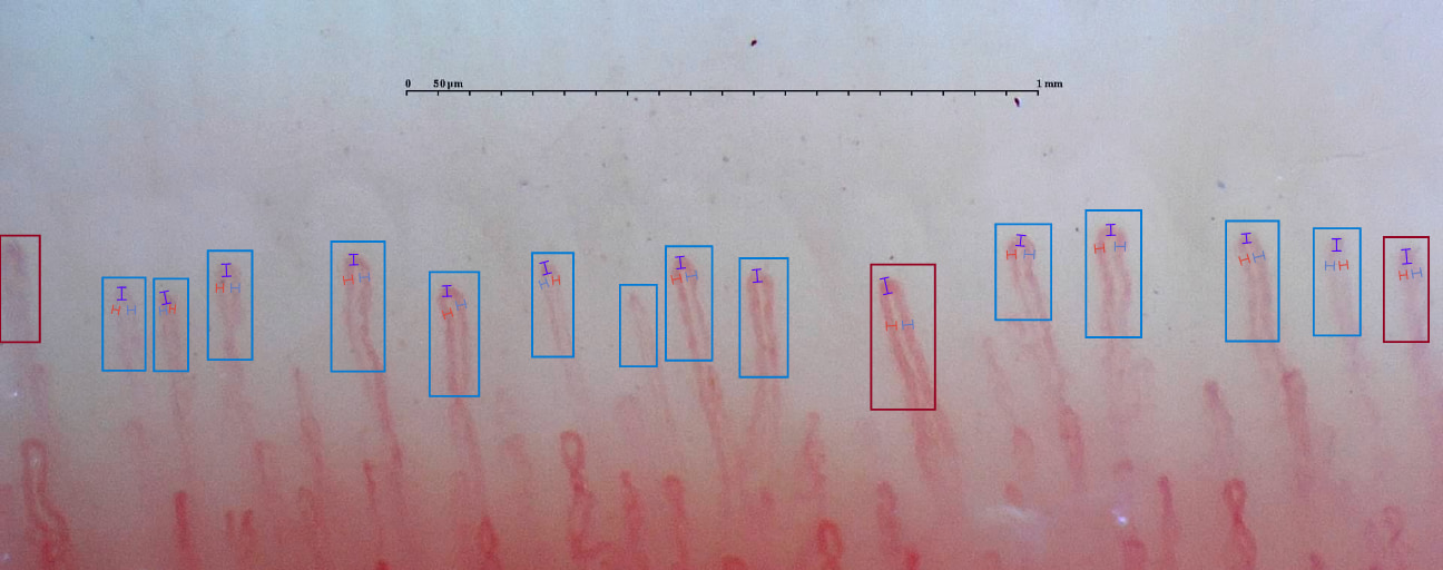 Esempio di capillaroscopia in cui si possono osservare capillari normali