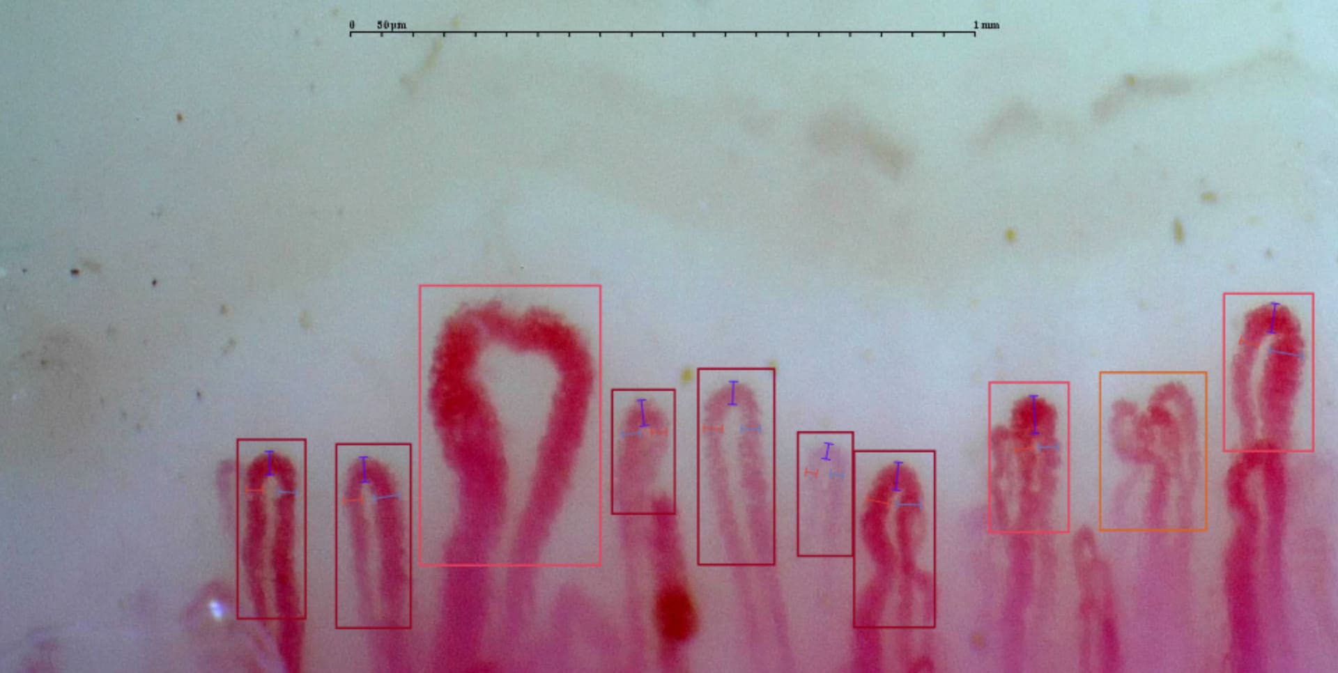 Esempio di capillaroscopia in cui si possono osservare capillari ingranditi e giganti