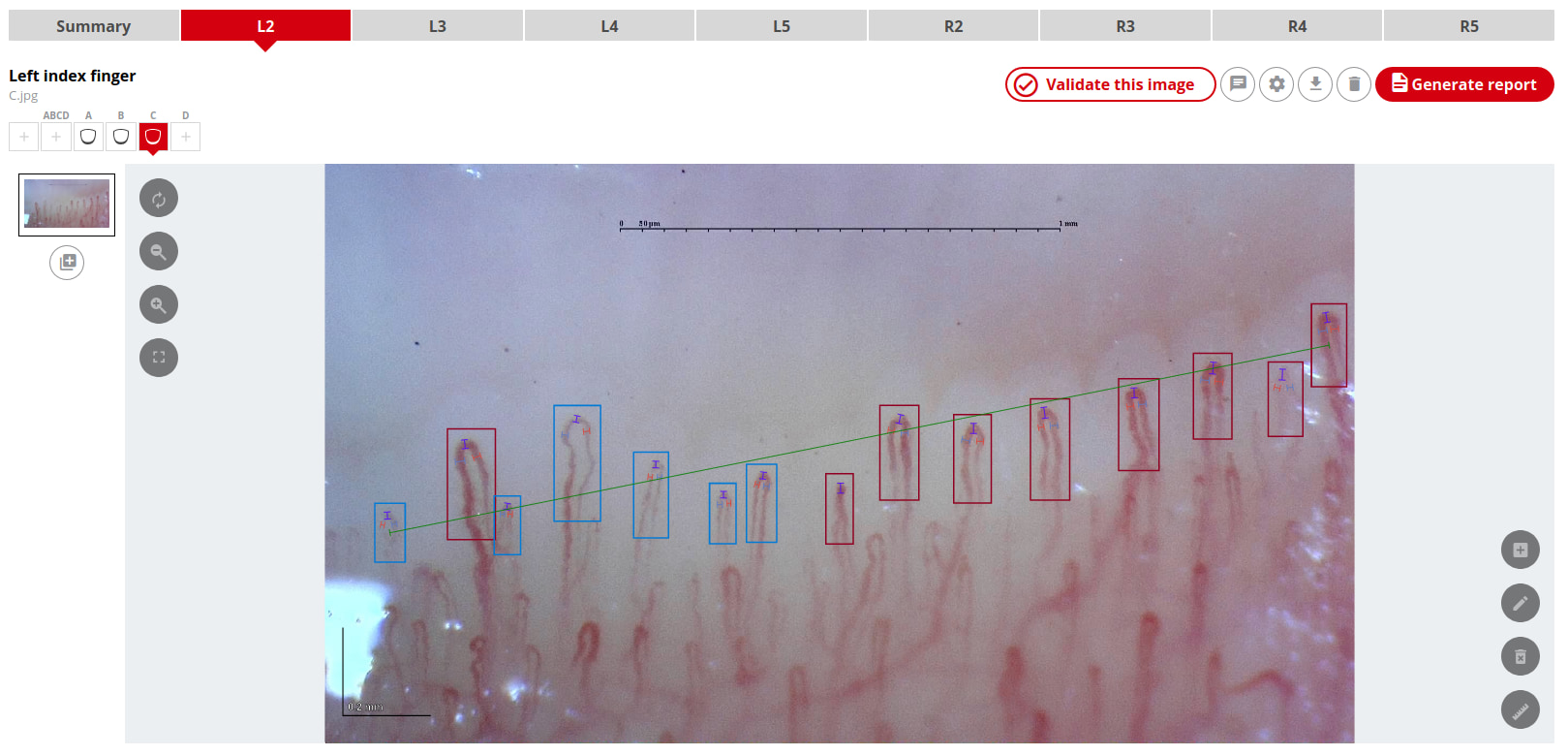 Il sistema Capillary.io automatizza il rilevamento, la misurazione e la classificazione dei capillari in tutte le vostre immagini di capillaroscopia delle unghie.
