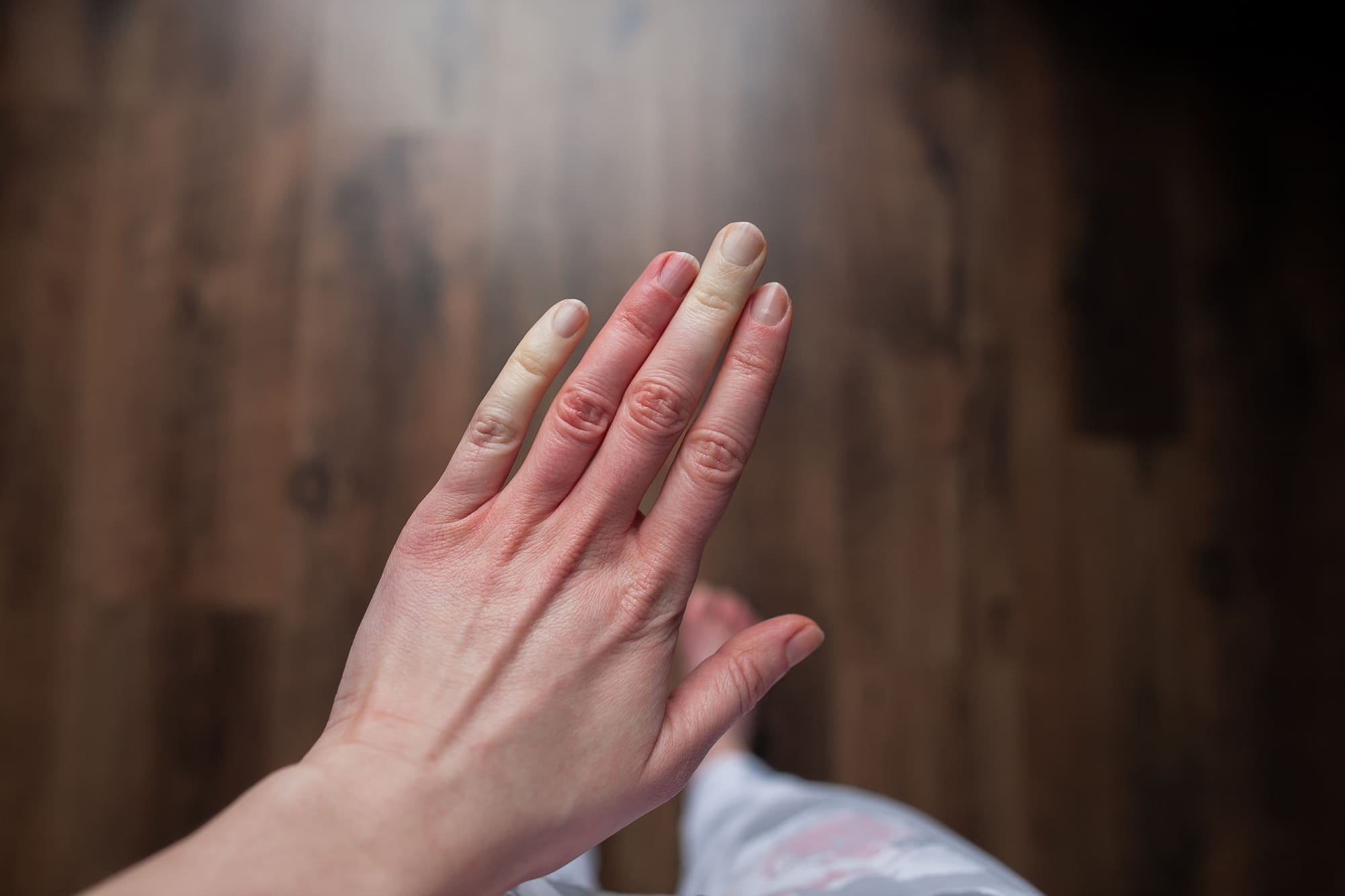 In questo articolo puoi scoprire l'importanza della capillaroscopia ungueale nel fenomeno di Raynaud.