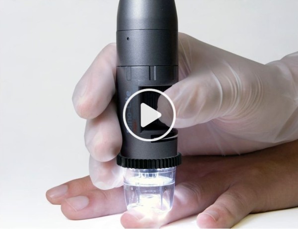 Video del capillaroscopio Dino-Lite CapillaryScope 200 Pro