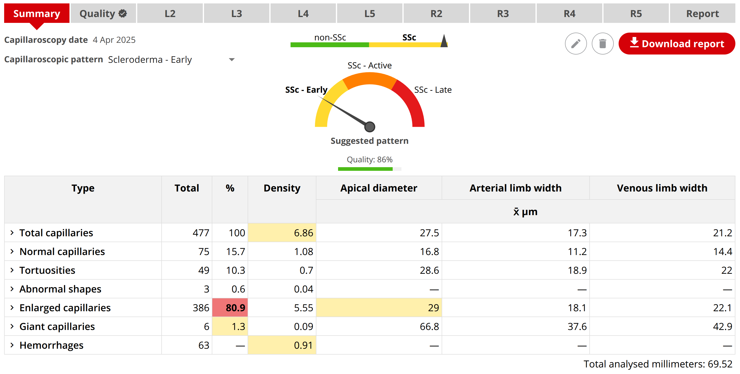 Capillary.io produce un report quantitativo immediato basato sull'analisi delle immagini che compongono una capillaroscopia, permettendoti di accedere in modo rapido ed efficace ai risultati più importanti. Inoltre fornisce un suggerimento del pattern della capillaroscopia basato sui risultati quantitativi, utilizzando il nostro algoritmo CAPI-Detect.