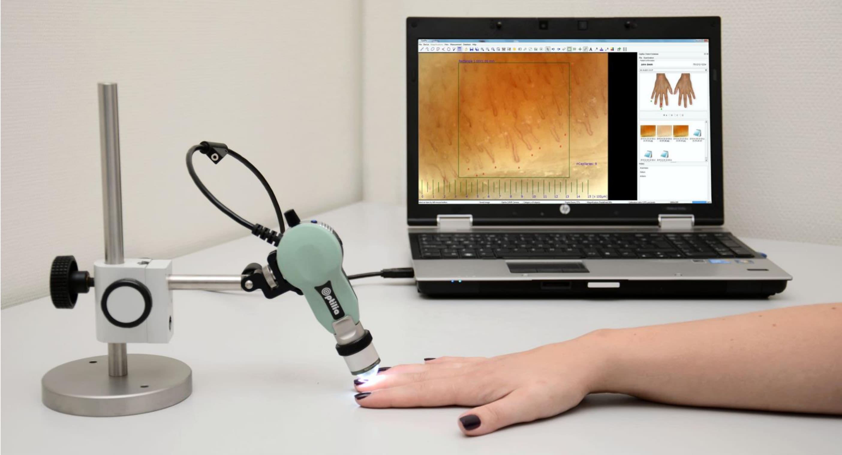 Procedura di capillaroscopia - I capillari alla base delle unghie sono osservati utilizzando un microscopio USB portatile collegato al computer
