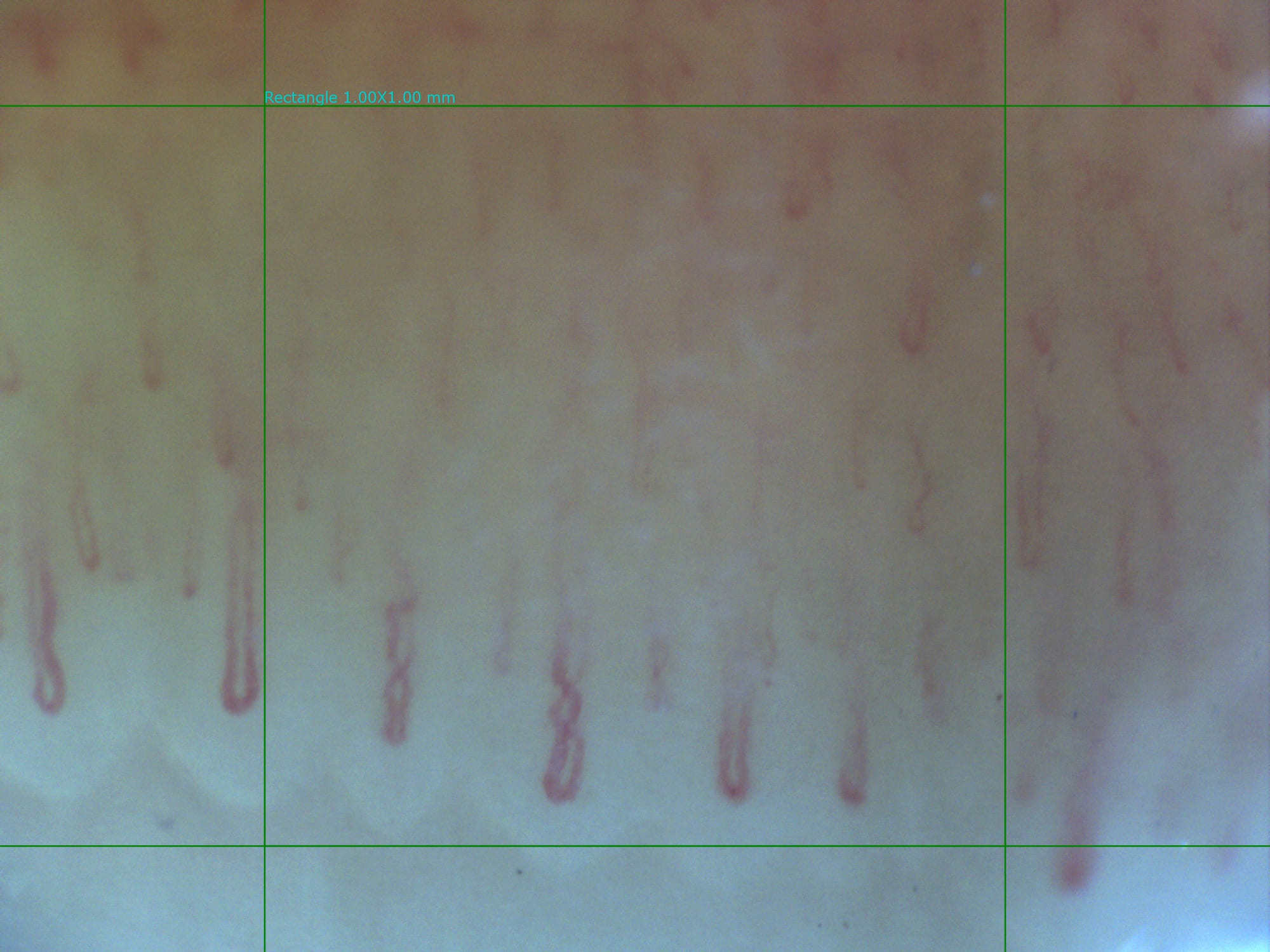 Esempio di capillaroscopia con Optilia Digital Capillaroscope